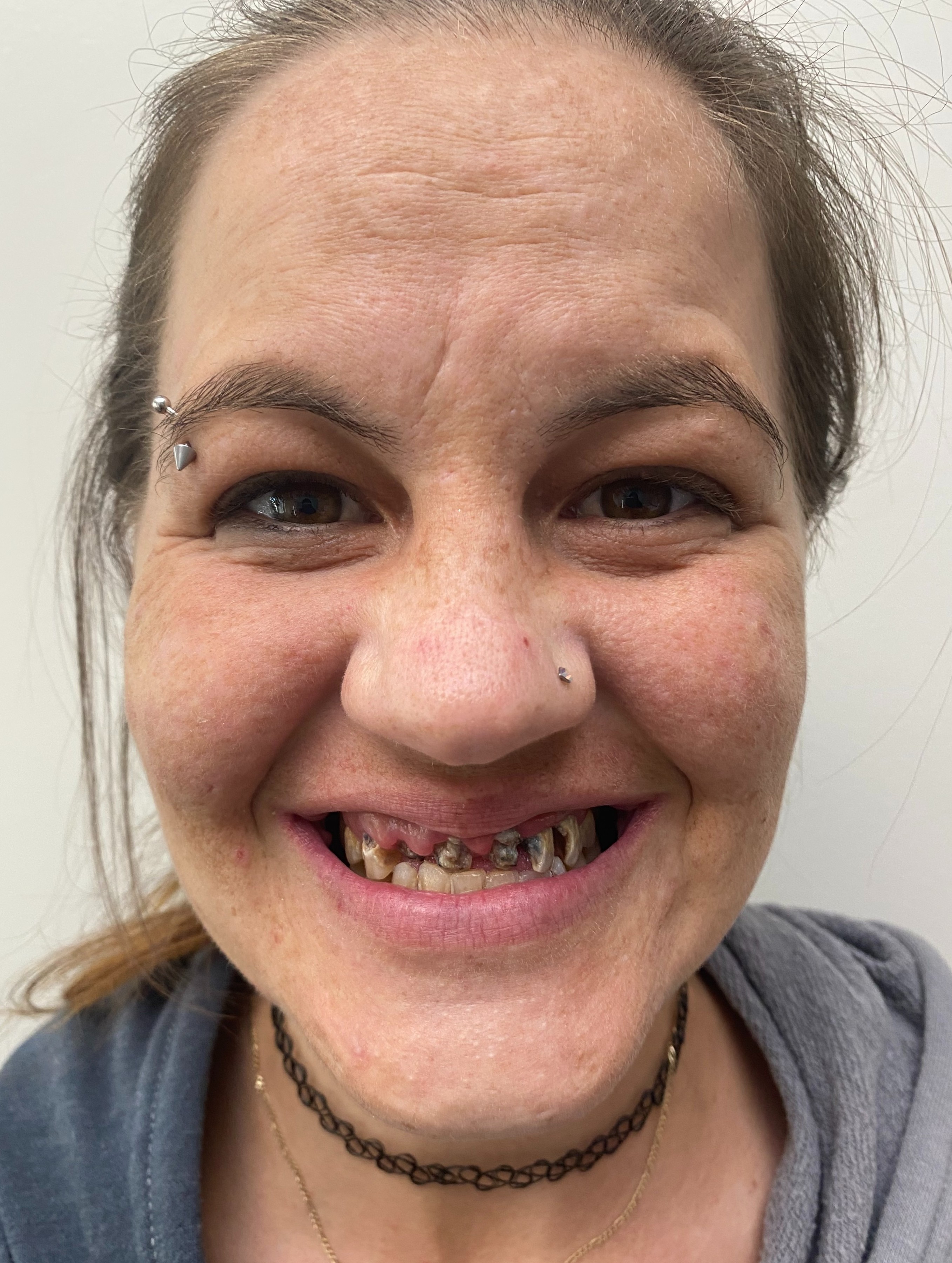 Patient before dental implant treatment — missing and damaged teeth