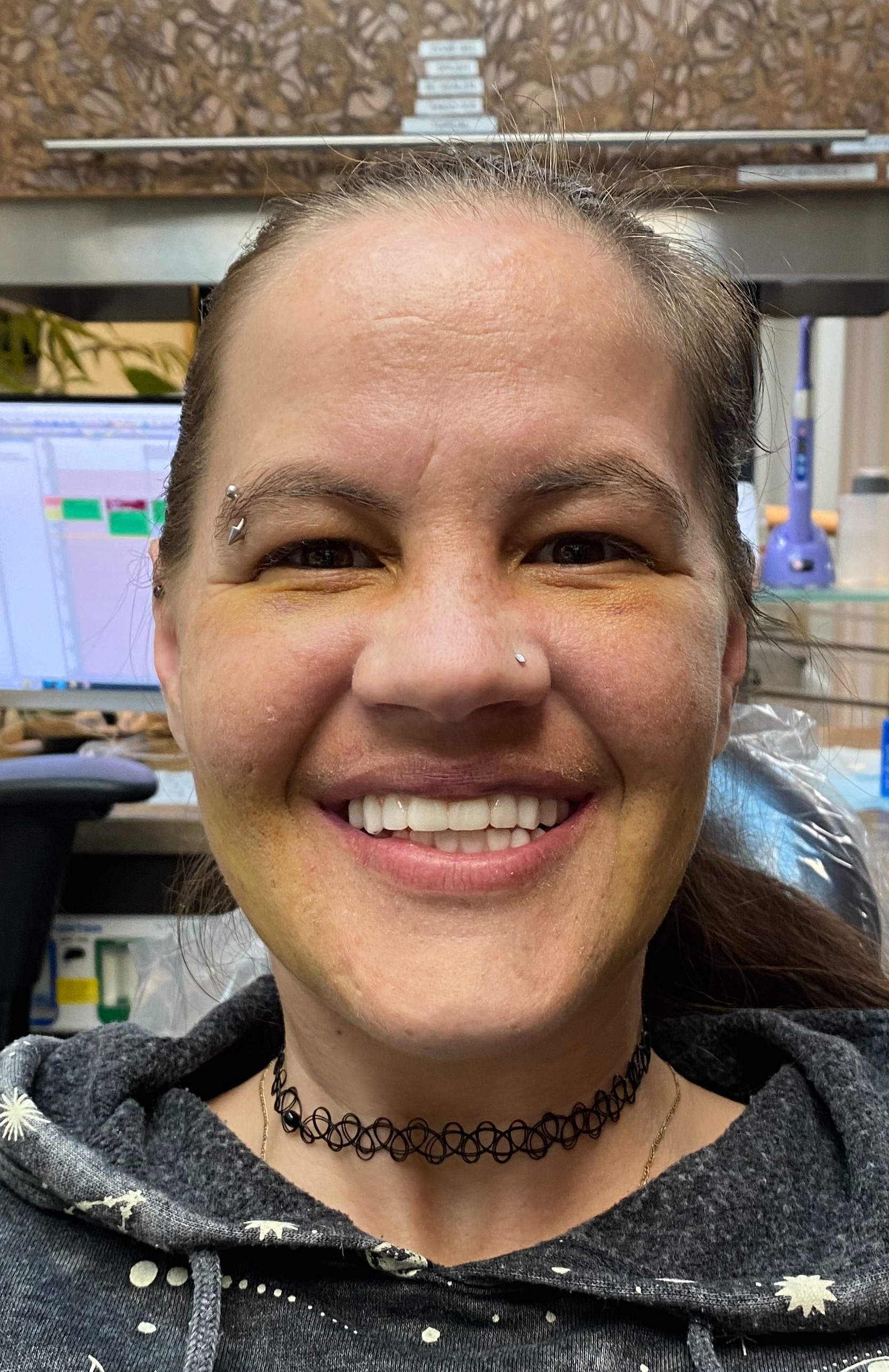 Patient after full arch dental implant restoration — beautiful natural smile